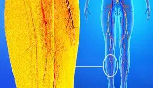 علل درد پشت ساق پا