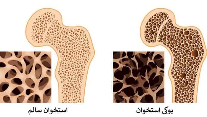 علائم پوکی استخوان