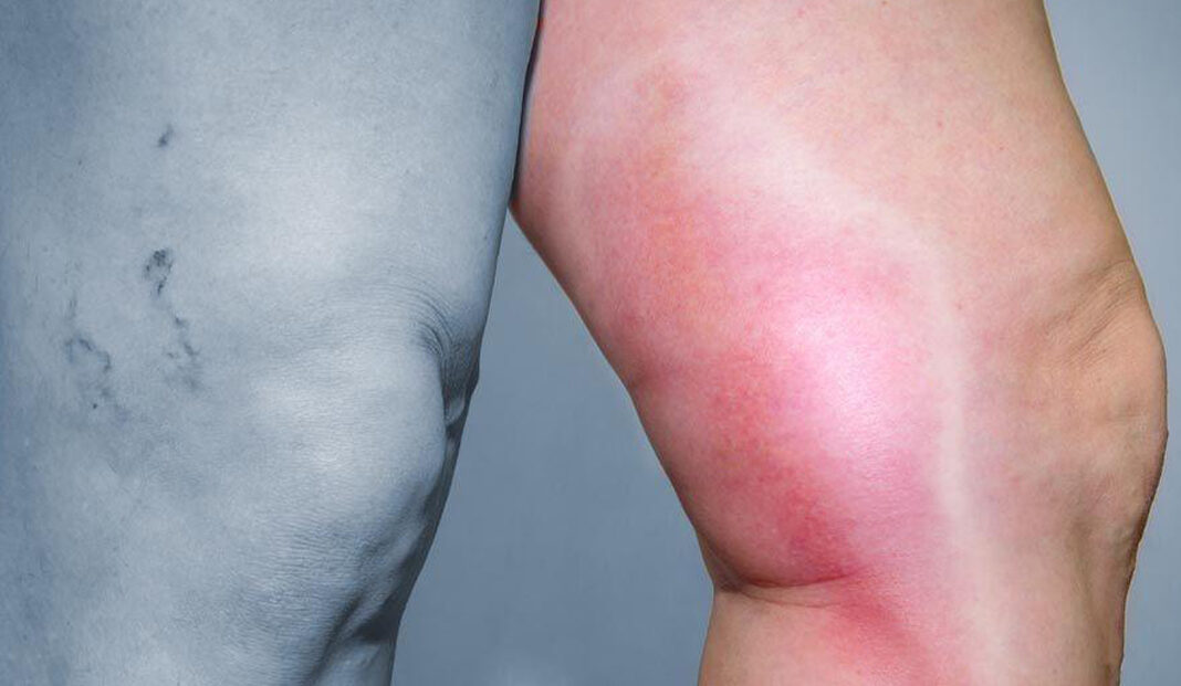 درد بالای ران