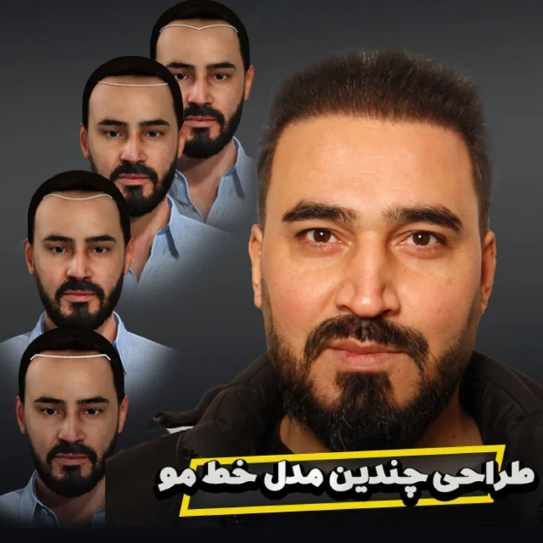 کاشت مو تهران با بهترین تیم پزشکی کاشت مو خاورمیانه