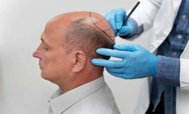 بهترین شرایط رنگ مو برای پیوند زدن کاشت مو چیست؟