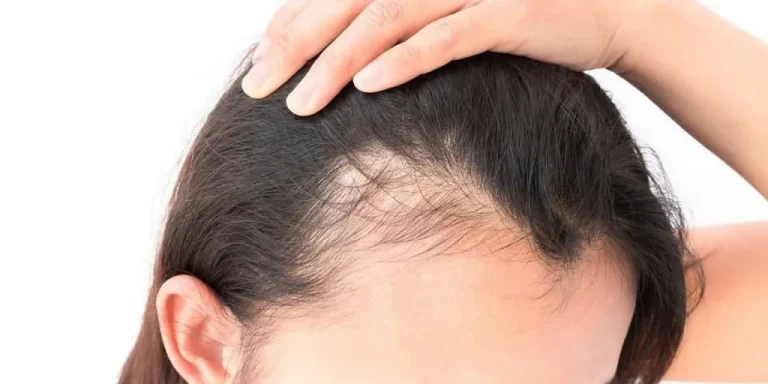 آیا استفاده از مواد شیمیایی می تواند ریزش مو را تشدید کند؟