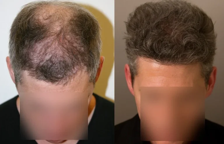 کاشت مو چیست و چگونه انجام می شود ؟