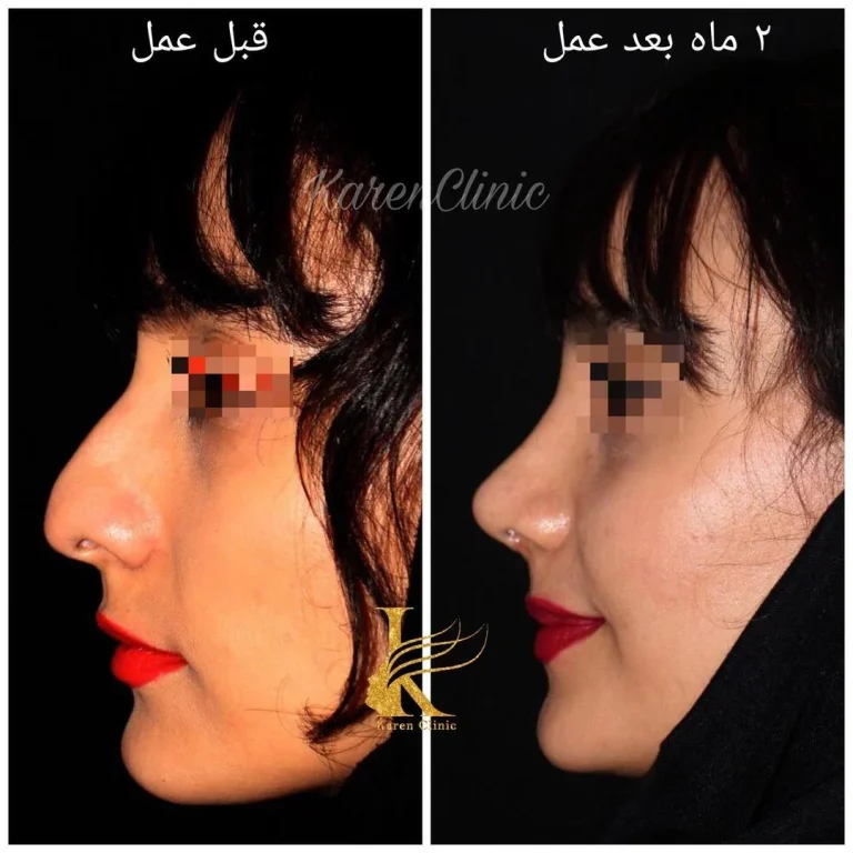 احتمال مرگ در جراحی بینی چقدر است؟