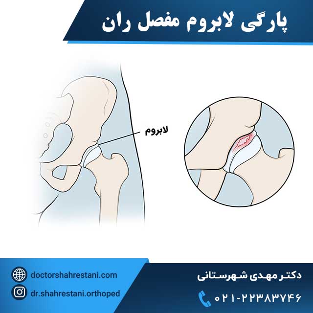 پارگی لابروم مفصل ران