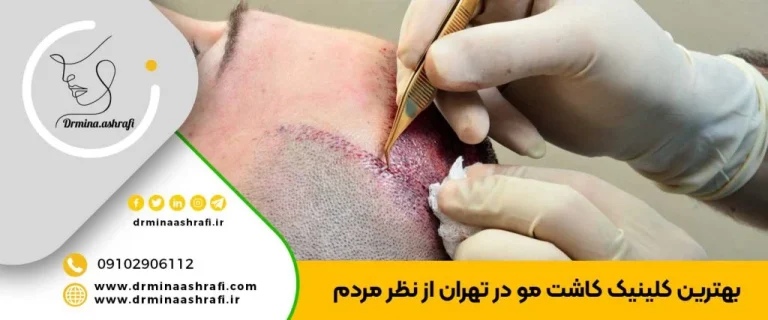 بهترین کلینیک کاشت مو در تهران را بشناسید
