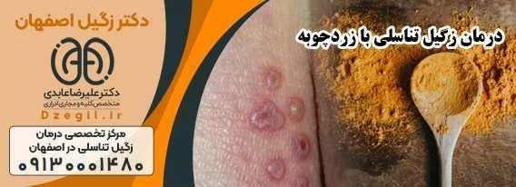 درمان زگیل تناسلی با زردچوبه و بهبود تبخال تناسلی در افراد مجرد
