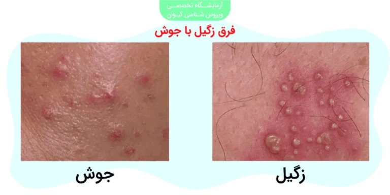 درمان زگیل با سیر سیاه