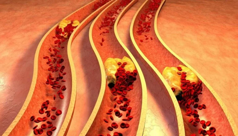علائم چربی خون در بارداری؛ راهنمای جامع تشخیص، عوارض و مدیریت ایمن