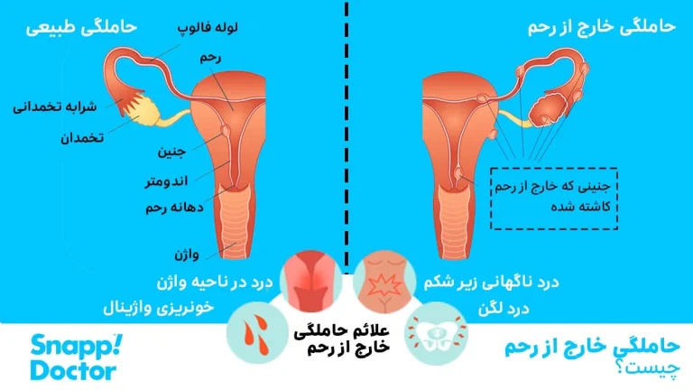 علائم بارداری خارج از رحم