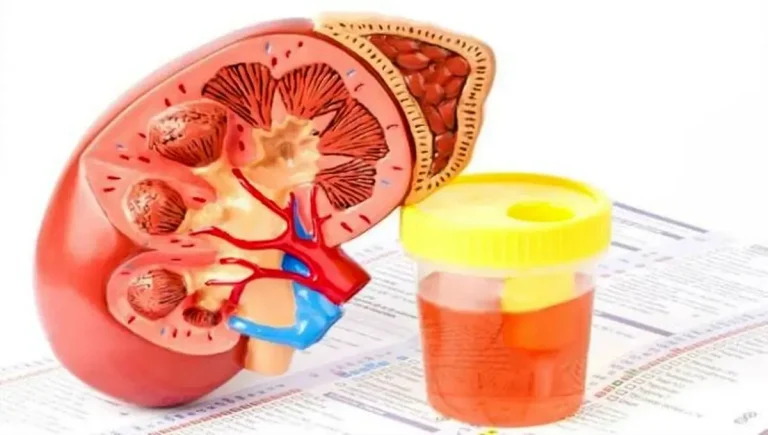 علت خون در ادرار (هماتوری): علائم، تشخیص و درمان جامع + راهکارهای پیشگیری