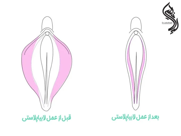 عکس قبل و بعد از عمل لابیاپلاستی