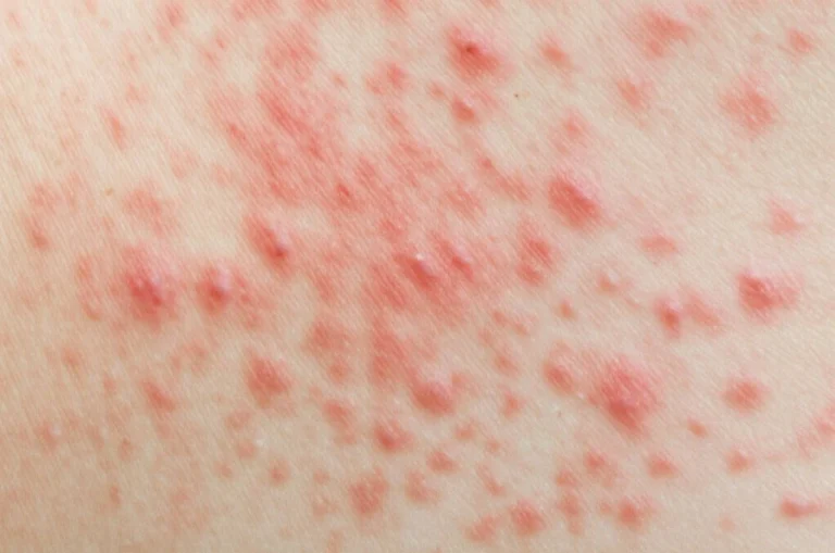 کهیر حاد؛ بررسی جامع علل، علائم و جدیدترین روش های درمان