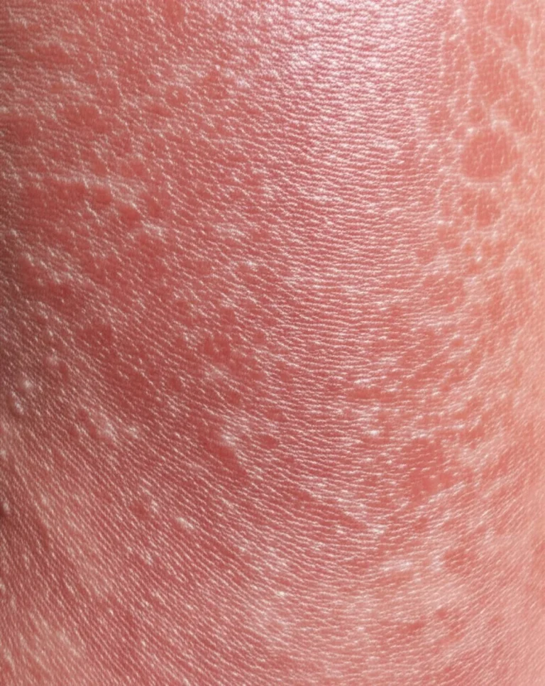 راهنمای جامع اریتروکراتودرمی واریابیلیس: علائم، علل ژنتیکی و روش‌های درمان