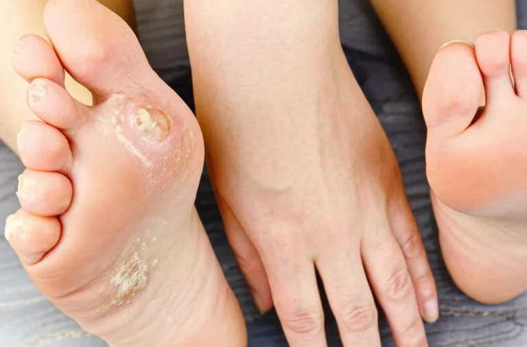 پاکی اونیشیای مادرزادی نوع ۱: راهنمای جامع علائم، ژنتیک و درمان های نوین