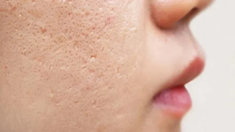 درمان منافذ باز پوست: راهنمای جامع روش‌های خانگی و کلینیکی