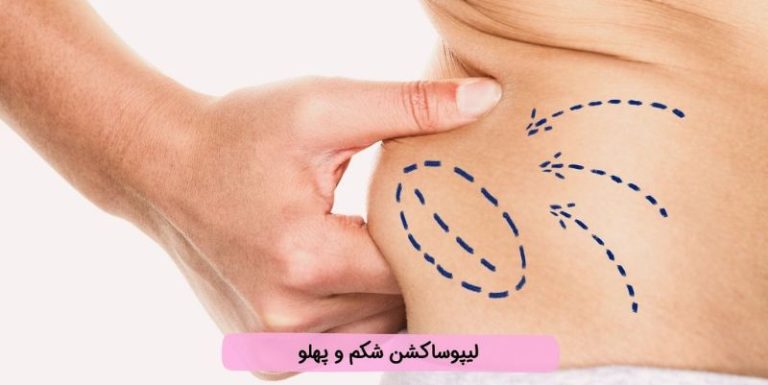 قیمت عمل ساکشن شکم و پهلو چقدر می شود؟